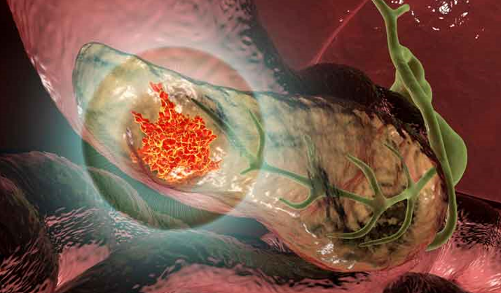 درمان بیماران سرطان پانکراس با استفاده از واکسن های mRNA شخصی سازی شده